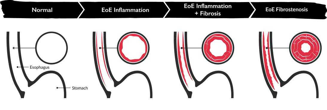 EoE endoscopy progression