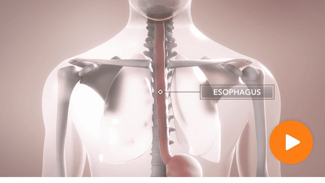Mechanism of Disease video about Eosinophilic Esophagitis (EoE), including where inflammation comes from and how it affects a patient's esophagus.